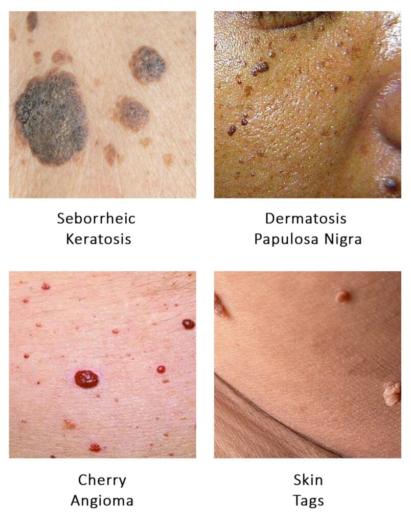 Age Spots Gilbert Perfect Skin