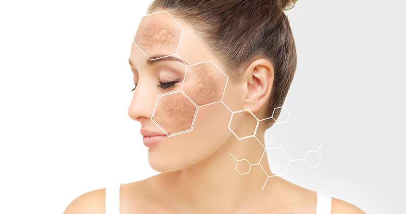 sun damage and age spots